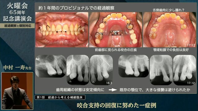 咬合支持の回復に努めた1症例│中村 一寿先生