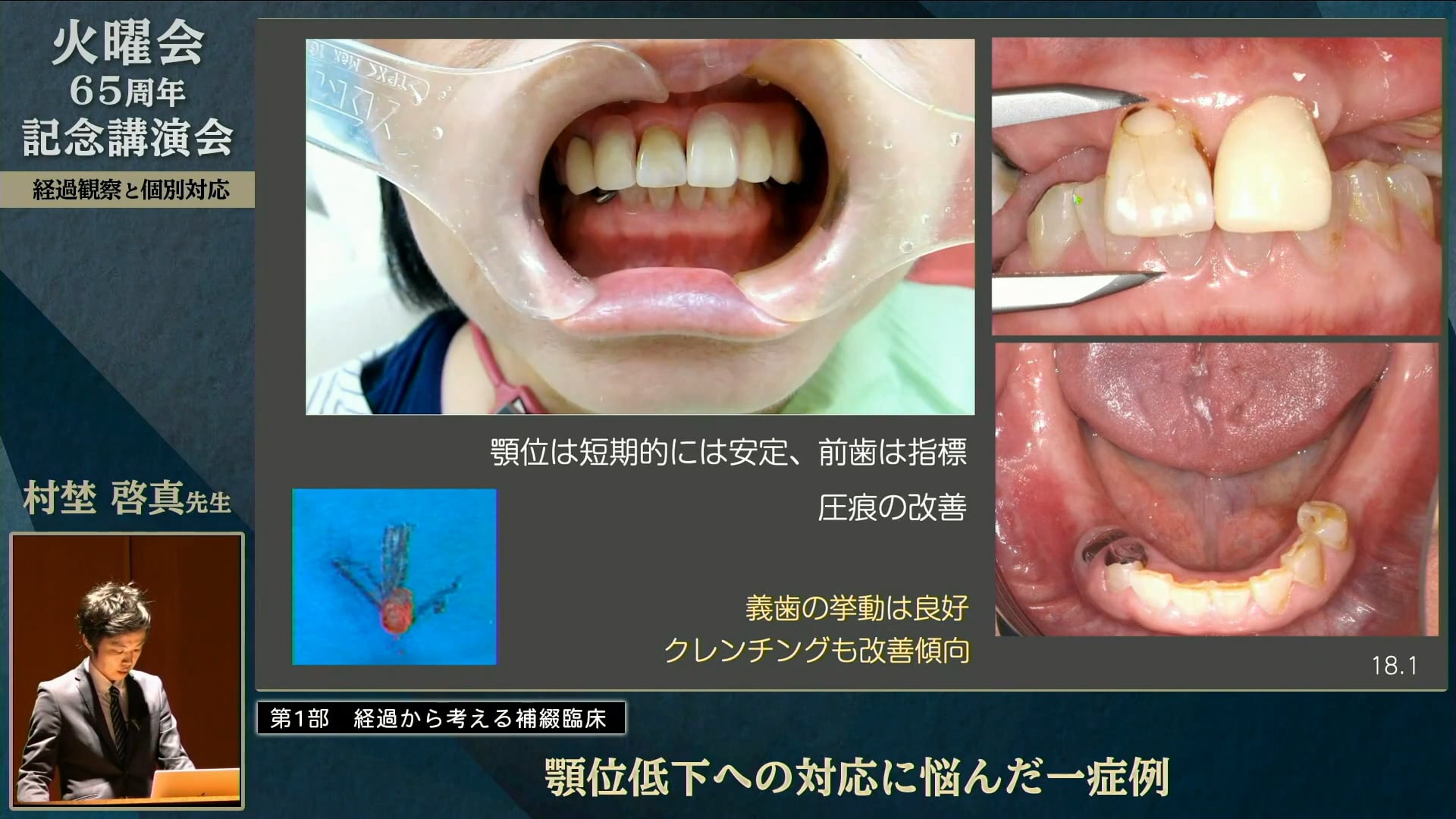 顎位低下への対応に悩んだ1症例│村埜 啓真先生