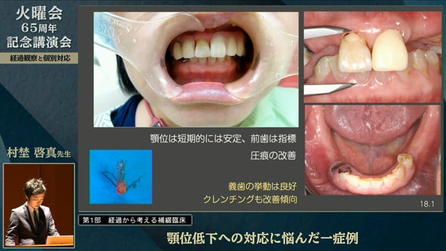 現代の臨床補綴 第2版: 歯周治療をふまえた補綴・インプラント