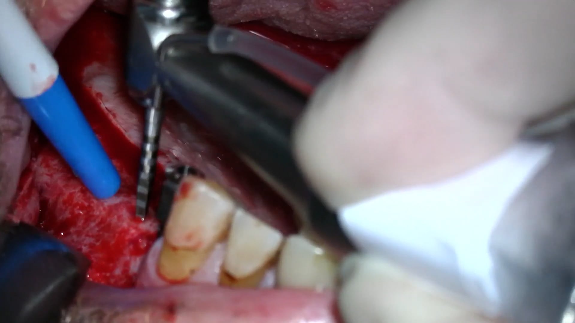 Reentrada y colocación implantes tras ESM en 2ºcuadrante y segunda fase 1er cuadrante