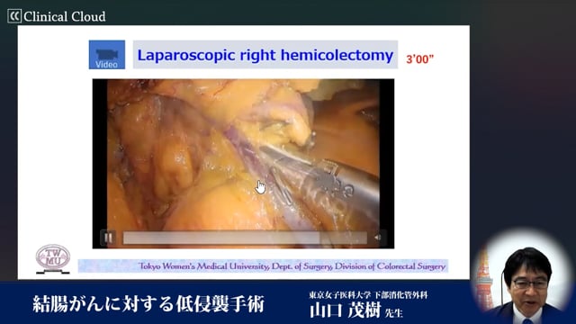 結腸がんに対する低侵襲手術 Part1