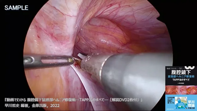 動画でわかる腹腔鏡下鼠径部ヘルニア修復術ーTAPP法のすべてー