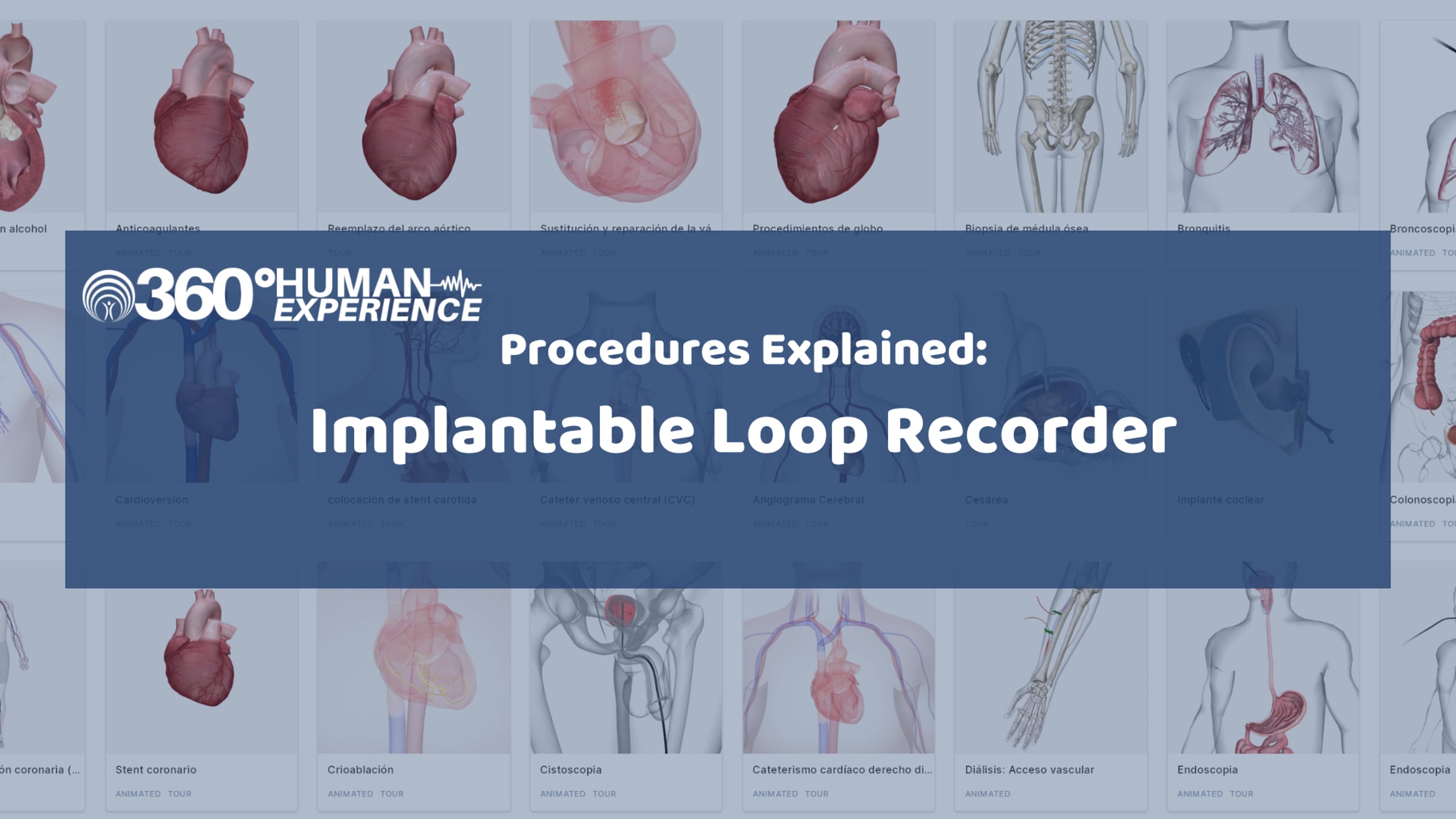 Implantable Loop Recorder: Procedure Explained | Videos & Movies on Vimeo