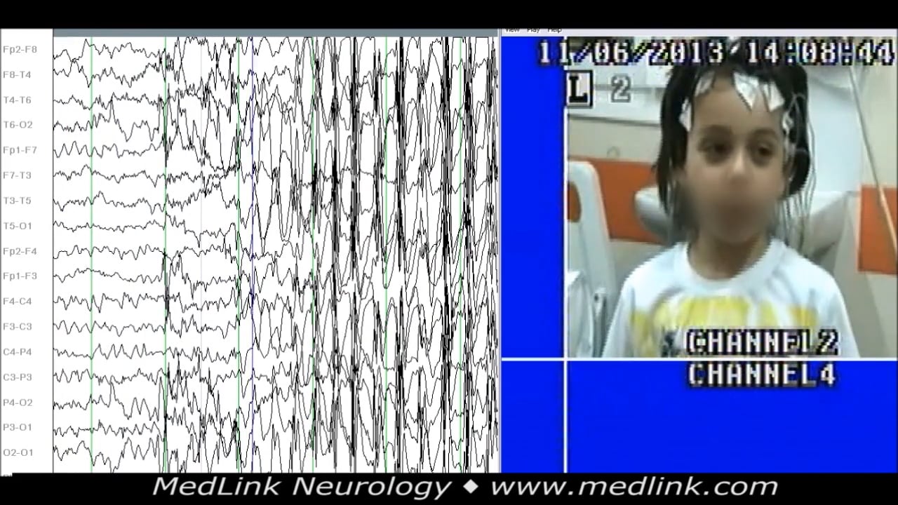 Typical absence seizures during hyperventilation