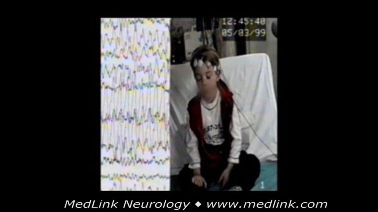 Childhood absence epilepsy (CAE) MedLink Neurology