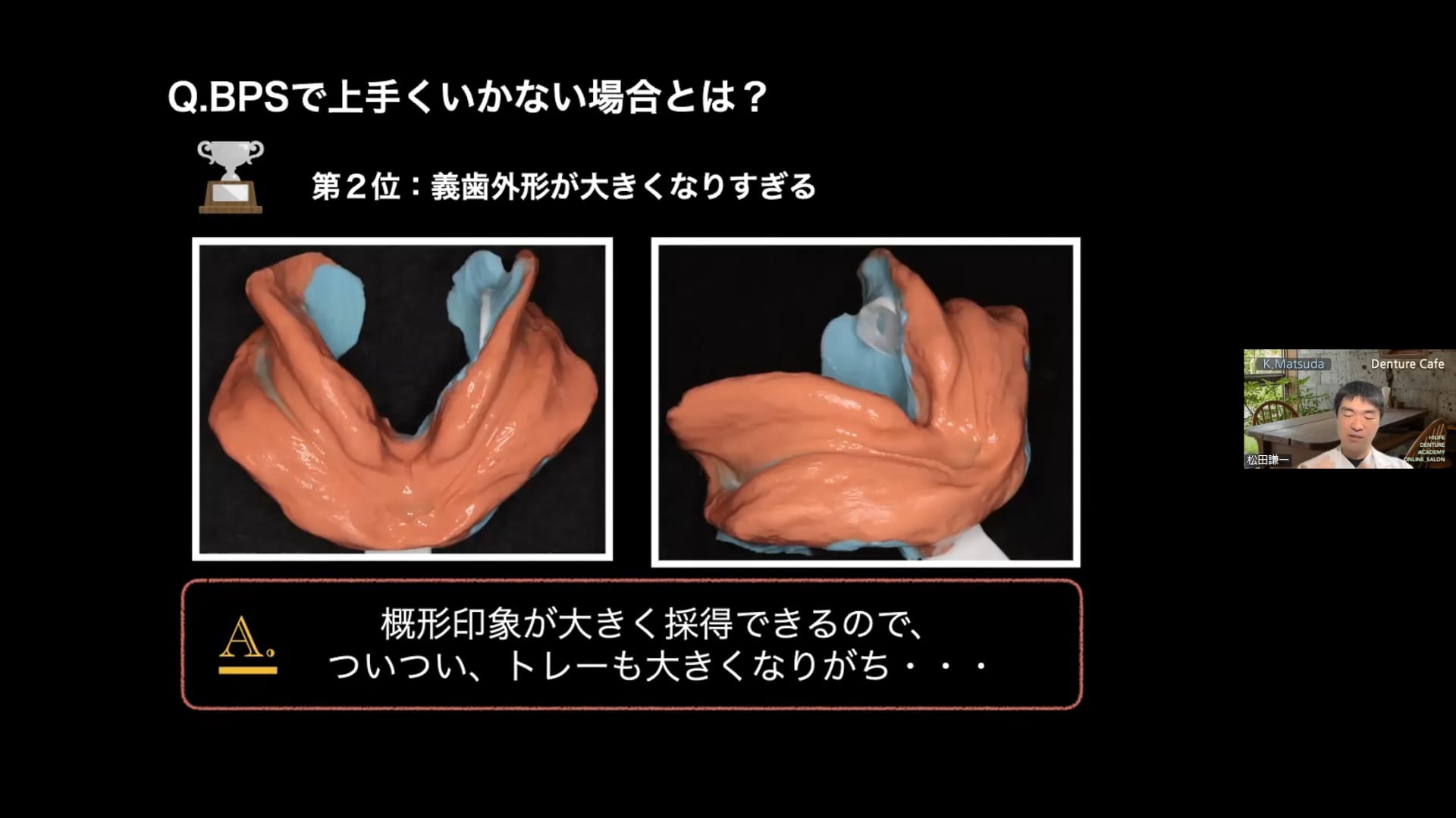 BPSのメリットとオススメの印象材 失敗しやすいポイントとは？ #2