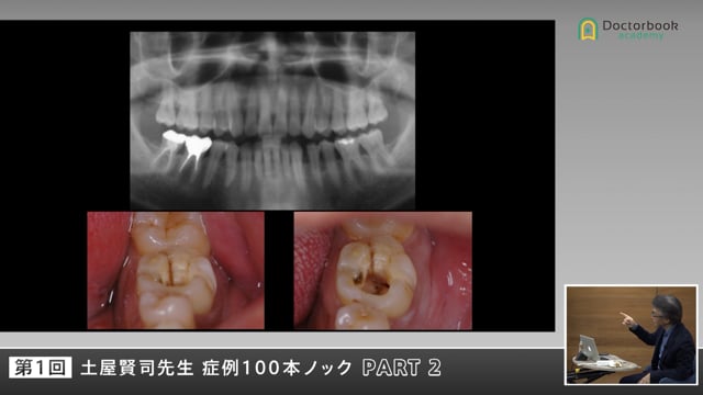 噛むと痛い患者をどう診る？疼痛と咬合の本質を探る #2