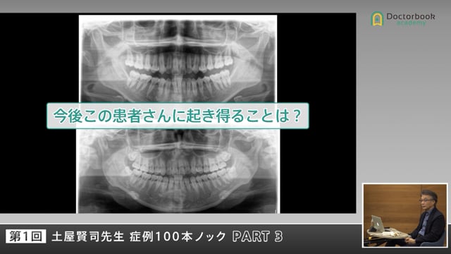 20代ノンカリエス症例と40代補綴症例の違い #3