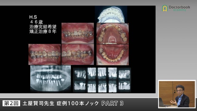矯正歴8年の症例―アンテリアガイドで導く再構築治療 #3