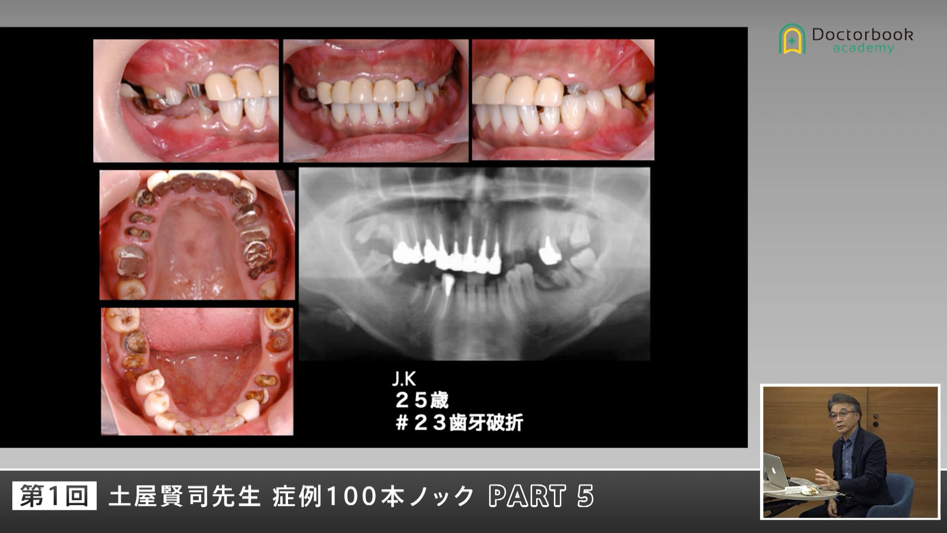 若年重度破折症例に学ぶ―患者様との信頼関係の重要性 #5