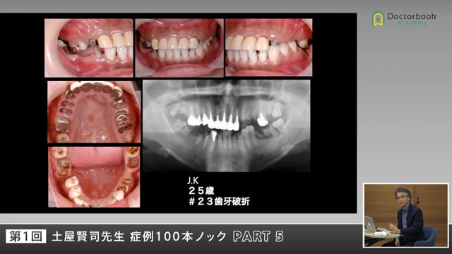 若年重度破折症例に学ぶ―患者様との信頼関係の重要性 #5