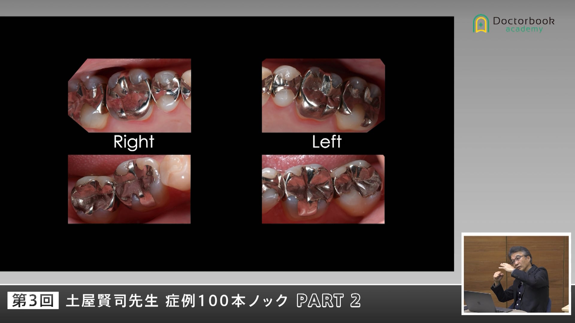 咬合の変化・干渉・力の影響を再考する症例 #2