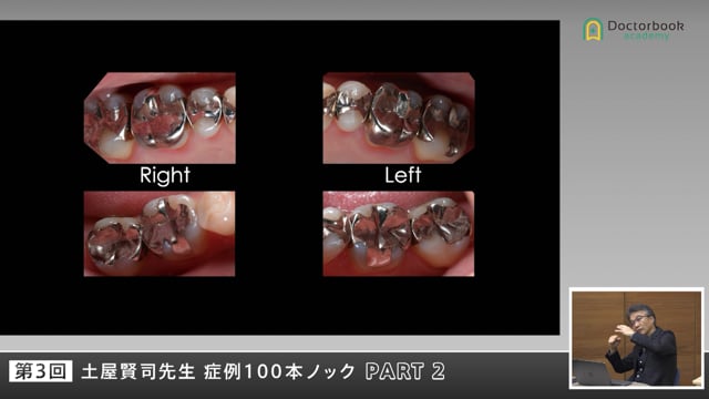 咬合の変化・干渉・力の影響を再考する症例 #2