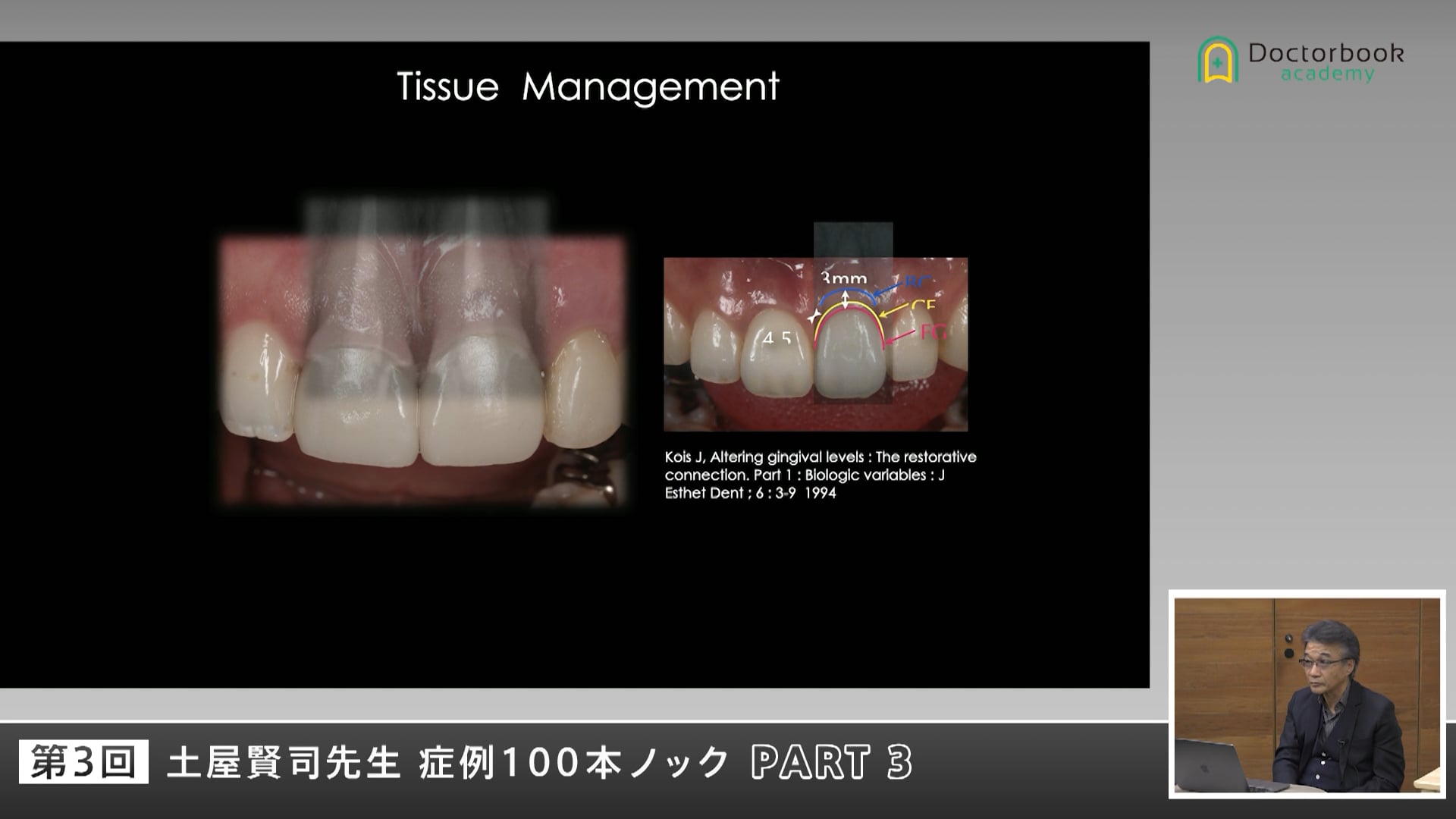 補綴、矯正、インプラントを融合した審美再建の実際 #3