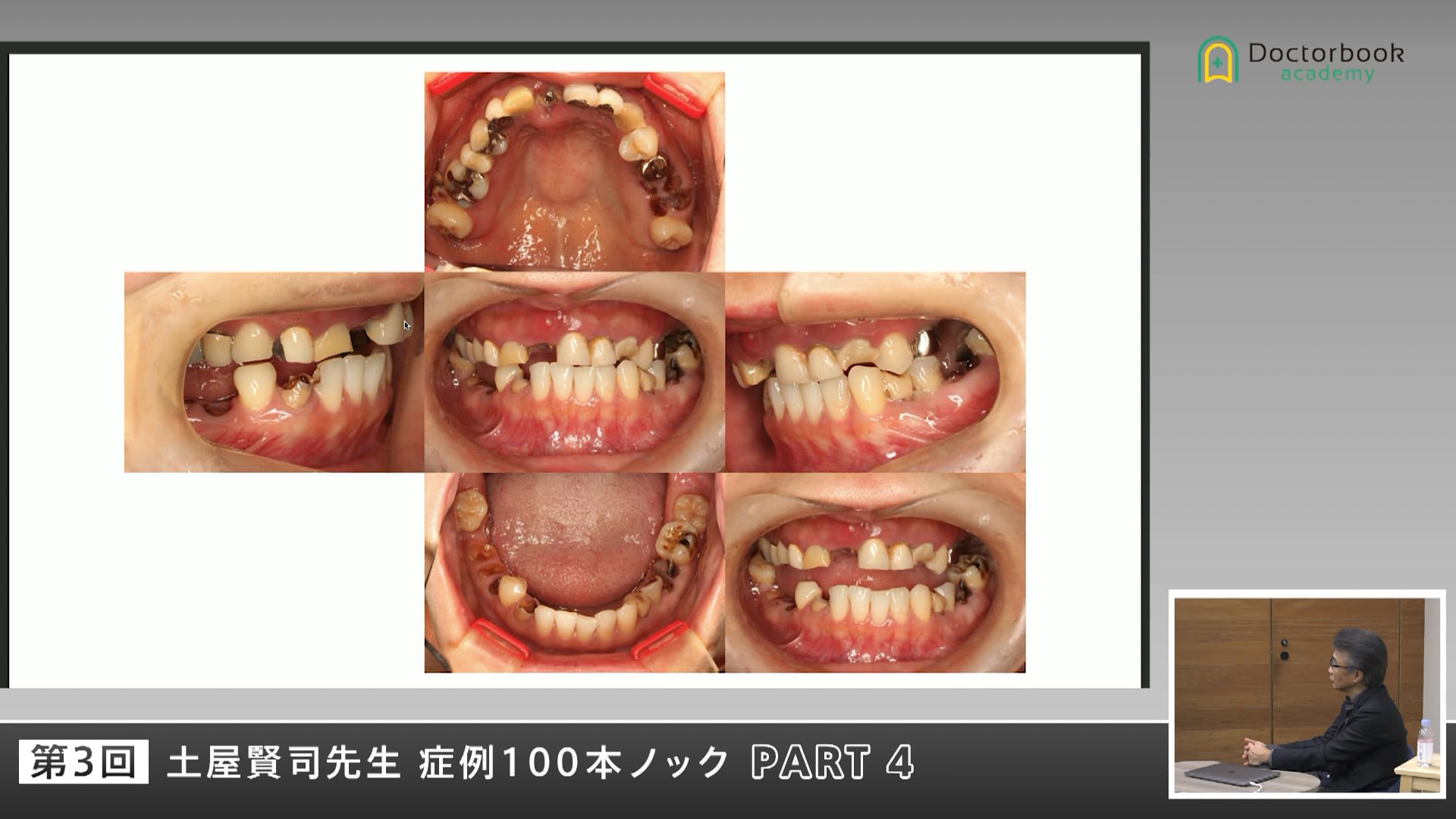 重度カリエスと咬合喪失を伴う若年女性症例ー信頼関係の再構築から始める全顎治療 #4