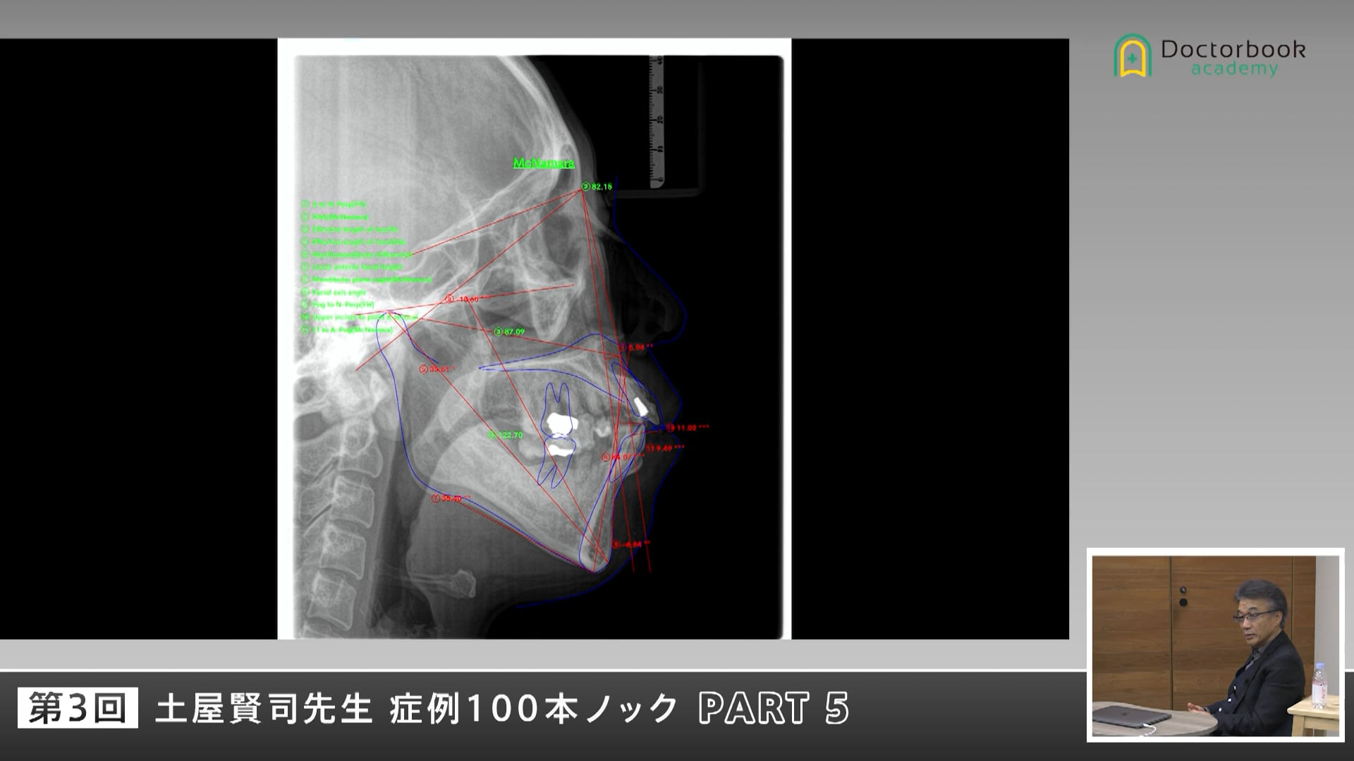 崩壊した咬合をどう立て直すかを考える症例ディスカッション #5
