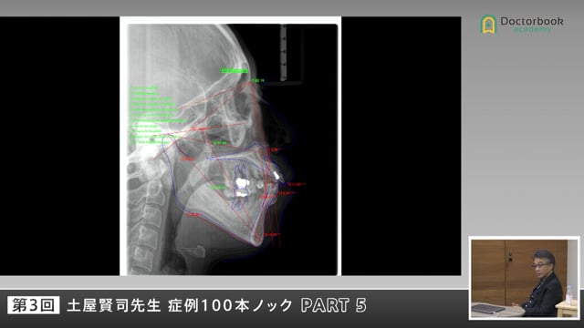崩壊した咬合をどう立て直すかを考える症例ディスカッション #5