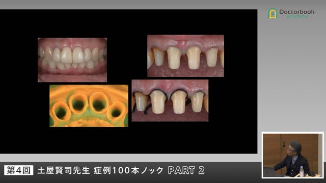 上顎前歯補綴を成功に導く診断とプロビジョナルの技術 #2
