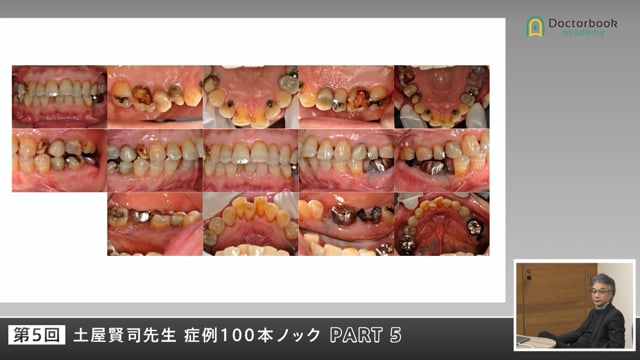信頼を取り戻すための説明術と咬合のコツ #5