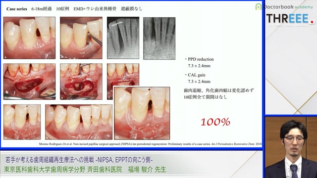 若手が考える歯周組織再生療法への挑戦 -NIPSA, EPPTの向こう側-│福場 駿介先生