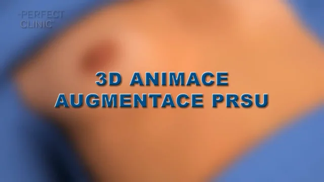 3D animace augmentace prsou Perfect Clinic