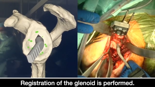 Glenoid component placement assisted by augmented reality through head-mounted display during RSA