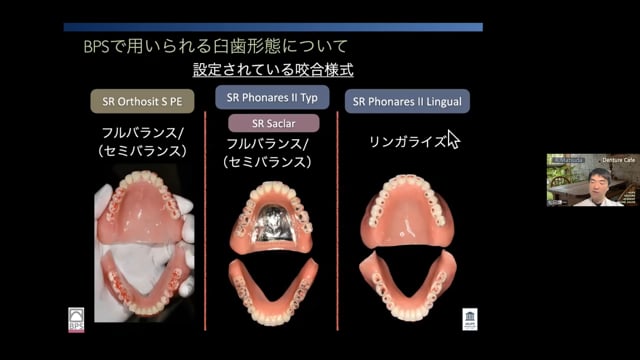 BPSにオススメの人工歯は？概形印象が大きくなった時の対応 #3