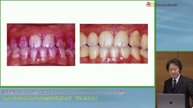 審美修復の新たな潮流 ～生活歯ホワイトニングとレイヤリングテクニックの実際～ #1