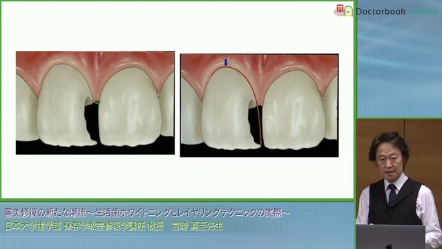 審美修復の新たな潮流 ～生活歯ホワイトニングとレイヤリングテクニックの実際～ #4