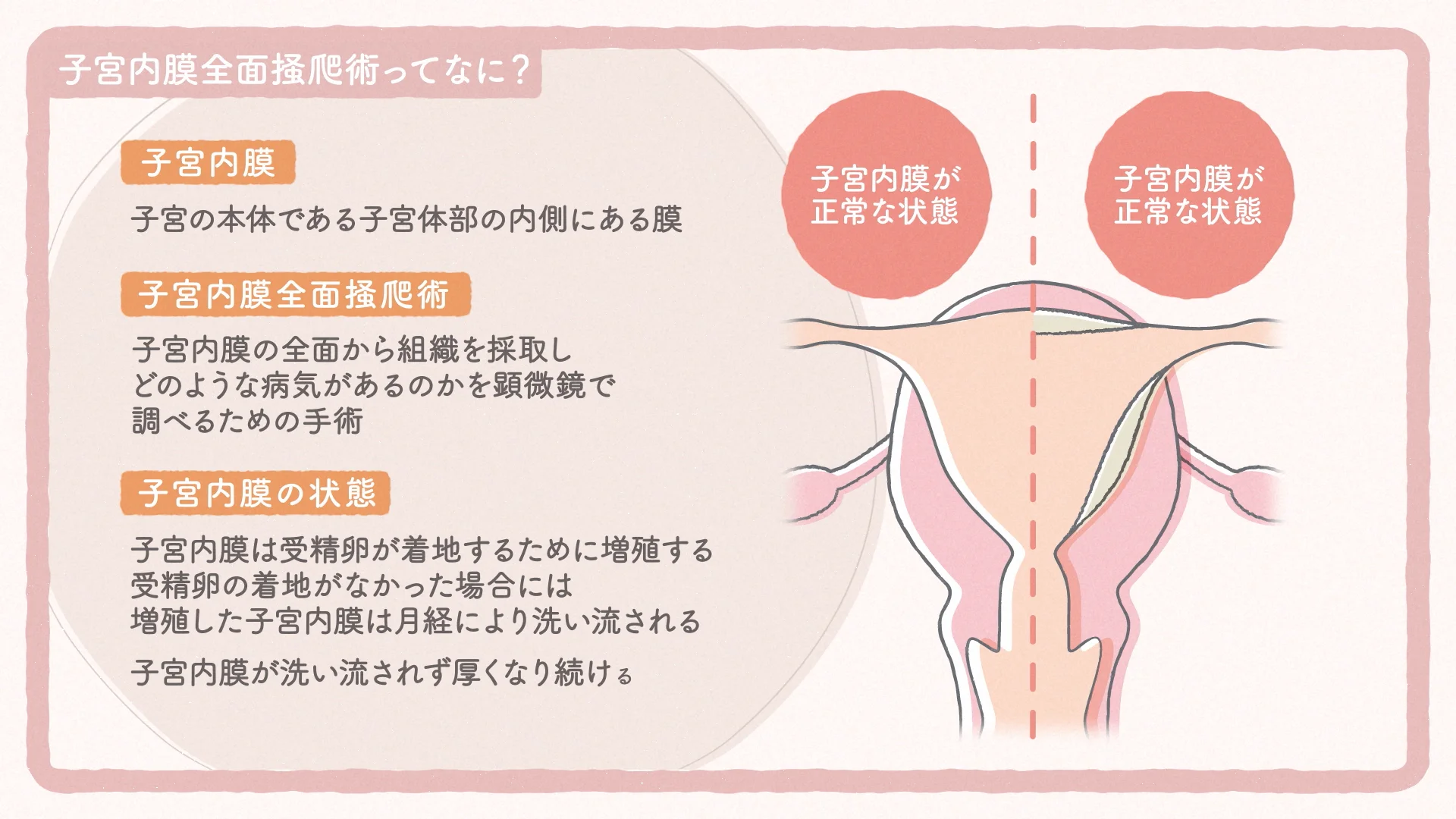 子宮内膜全面搔爬術 | 公益社団法人 日本婦人科腫瘍学会