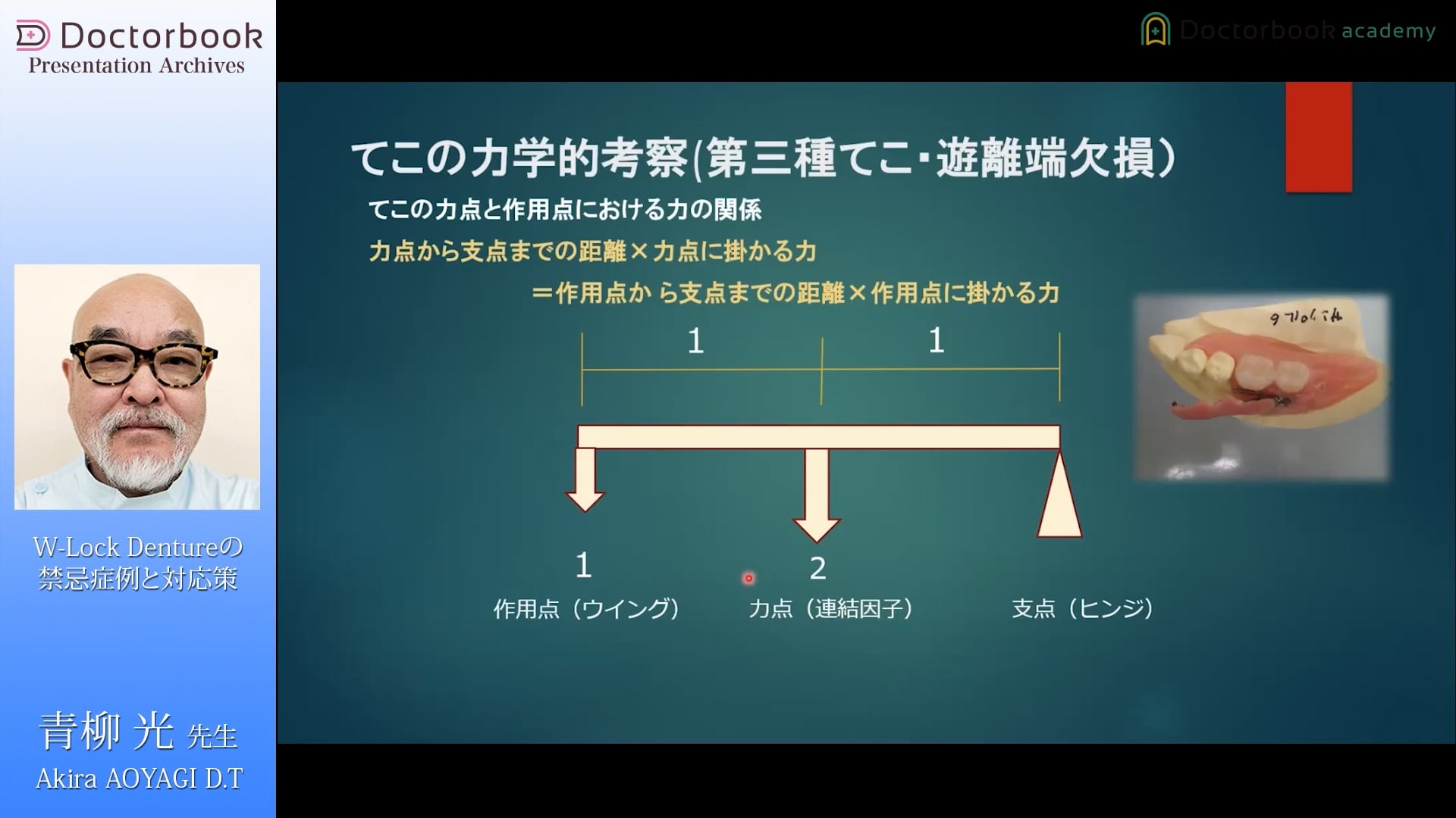 第7回 W-Lock Dentureの禁忌症例と対応策