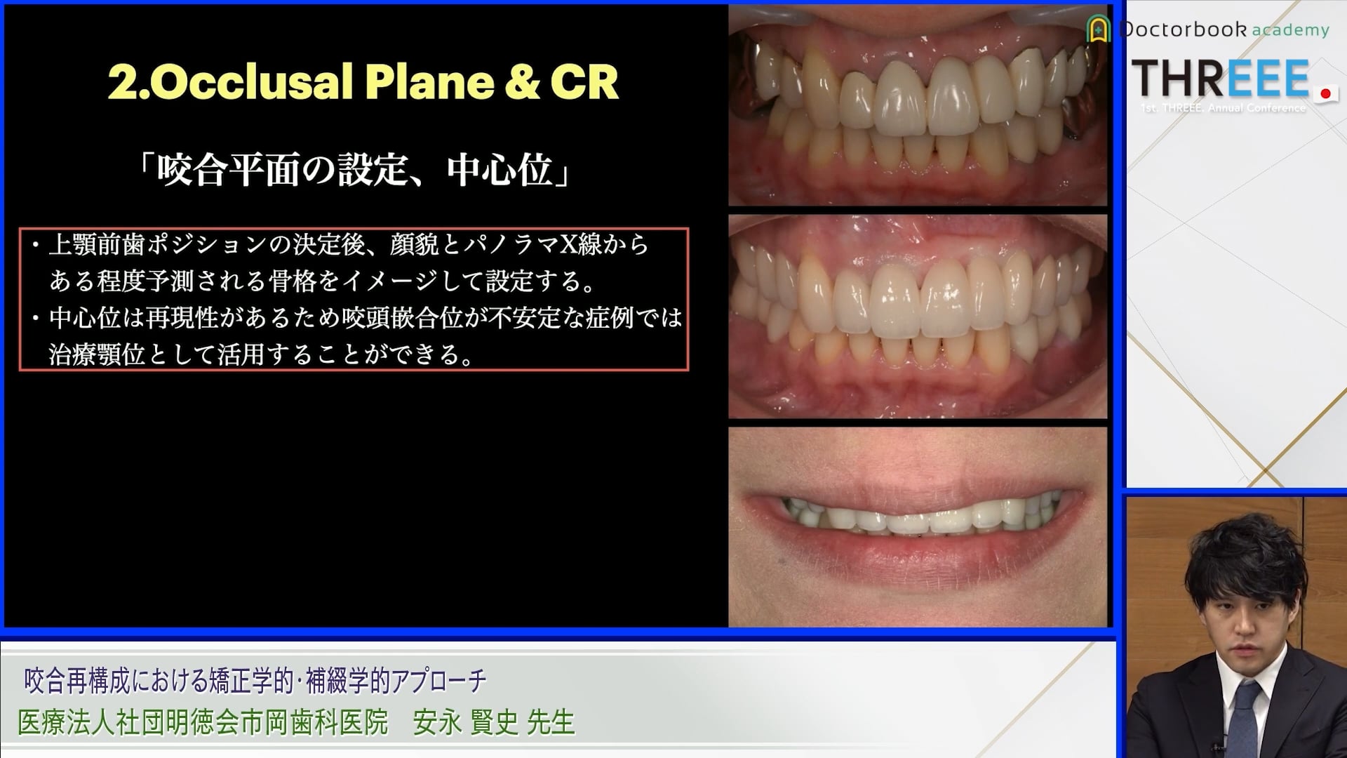 咬合再構成における矯正学的・補綴学的アプローチ│安永 賢史先生