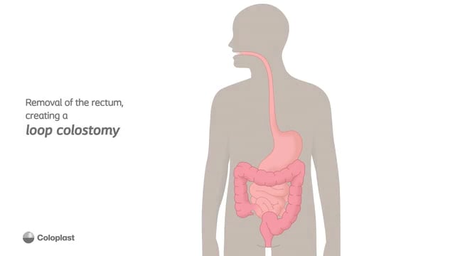 Loop colostomy removal of rectum on Vimeo