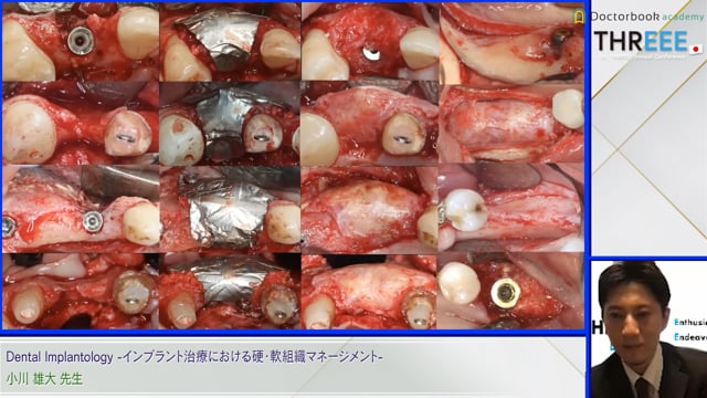 Dental Implantology -インプラント治療における硬・軟組織マネージメント-│小川 雄大先生