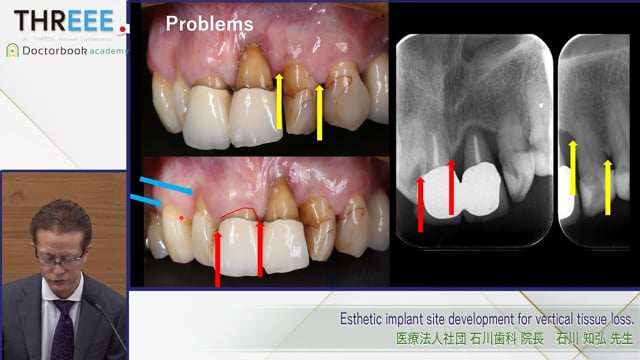 Esthetic implant site development for vertical tissue loss.│石川 知弘先生