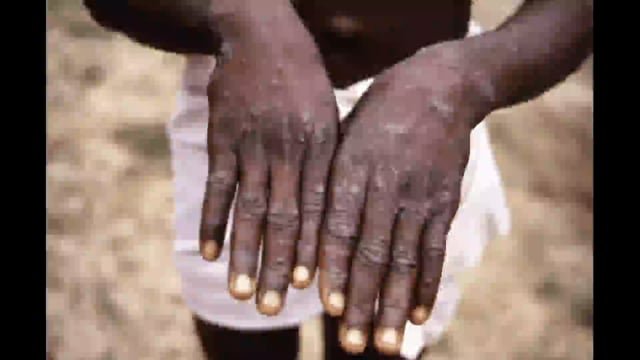 Monkeypox in Ohio - Here’s what you need to know about the virus – The Columbus Dispatch