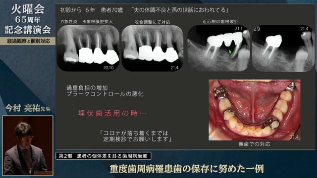 重度歯周病罹患歯の保存に努めた一例│今村 亮祐先生