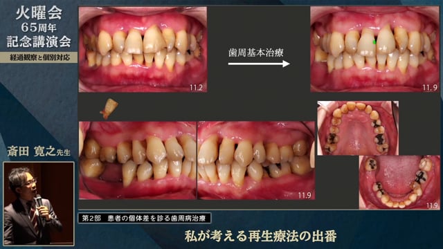 欠損歯列のみかた〜KA367から見えること〜│中舘 正芳先生