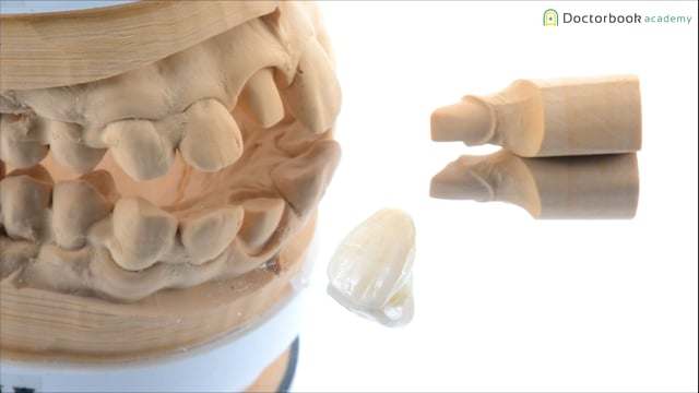 右上1番の失活歯単冠症例 #2