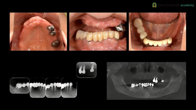 プライマリープロビジョナルレストレーション作成・支台歯形成のポイント・結合組織移植 #3