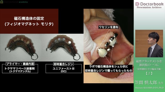 磁性アタッチメントをすでに使用している患者様の義歯新製のケース