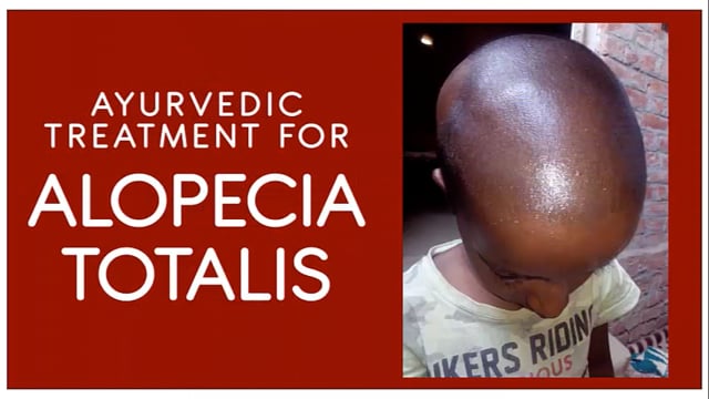Ayurvedic Treatment for Alopecia Totalis
