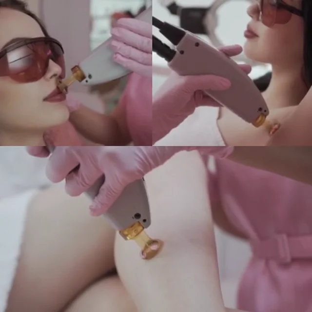 Laser Hair Removal.mp4