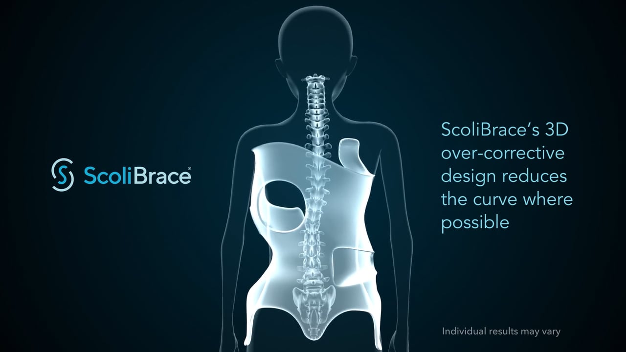 Spinal Technology  Full Time Scoliosis Orthosis - Wear and Care