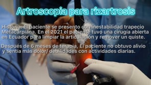 Procedimiento mínimamente invasivo para Rizartrosis usando #artroscopia