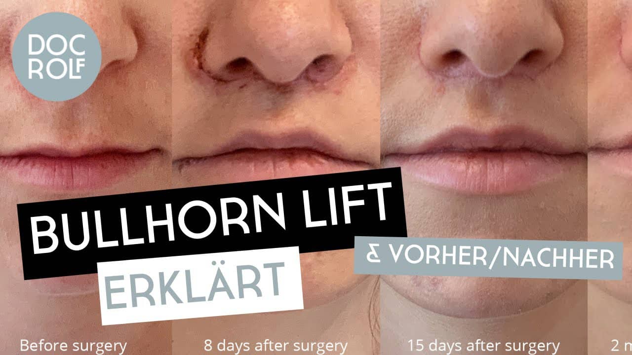 BULLHORN LIFT 2021 erklärt & vorher_ nachher by Dr Rolf Bartsch on Vimeo