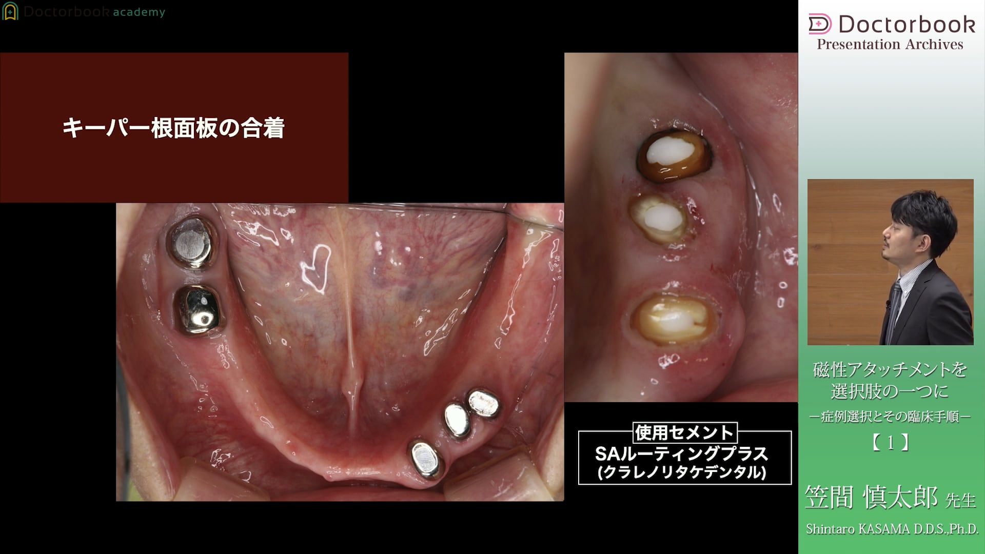 抜歯を回避したい患者様への磁性アタッチメントの応用