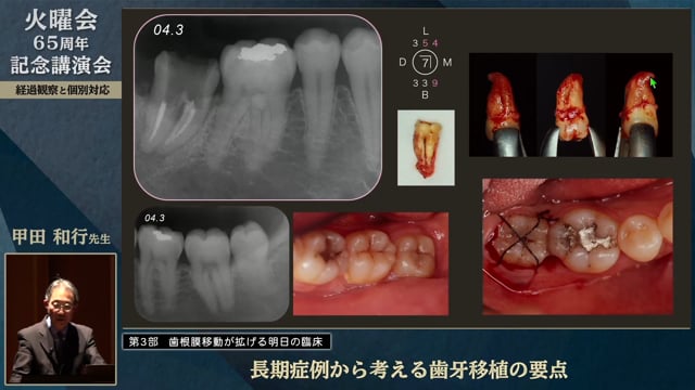 長期症例から考える歯牙移植の要点│甲田 和行先生