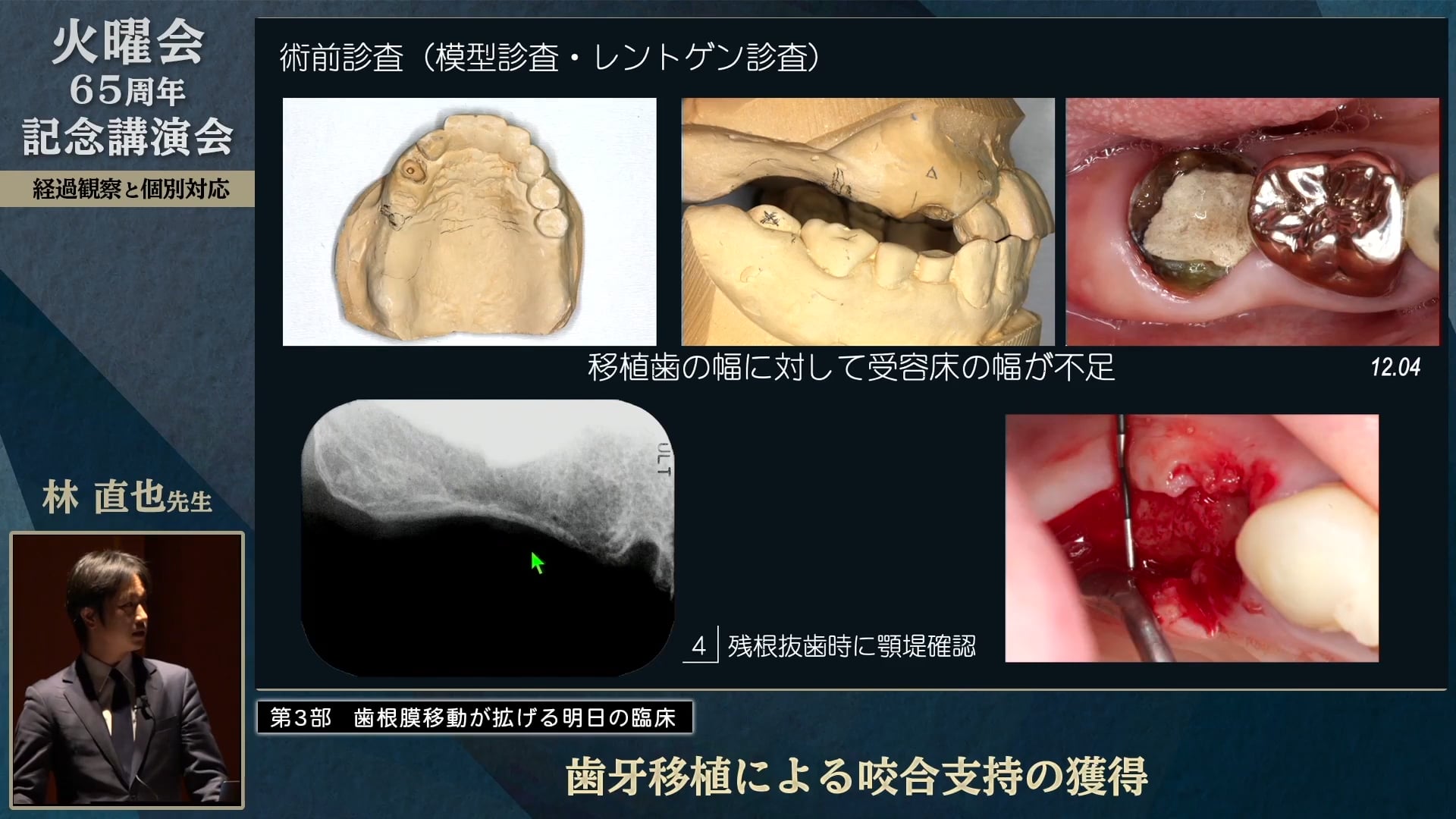 歯牙移植による咬合支持の獲得│林 直也先生