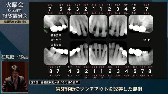 歯牙移動でフレアアウトを改善した症例│江尻 健一郎先生